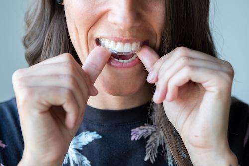 A woman putting in her Invisalign tray