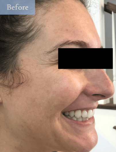 Patient's face before BOTOX® injections in Brandon, FL