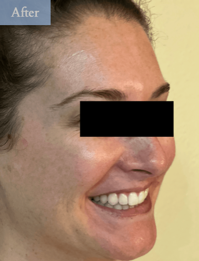 Patient's skin after BOTOX® injections at dentist in Brandon, FL