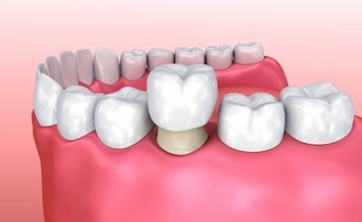 Diagram of dental crown covering tooth in Brandon, FL