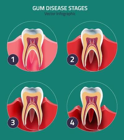 Diagram with stages of gum disease at dentist in Brandon, FL