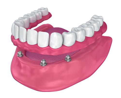 Bottom set of implant dentures in Brandon, FL