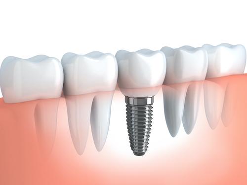 Diagram of dental implant in Brandon, FL
