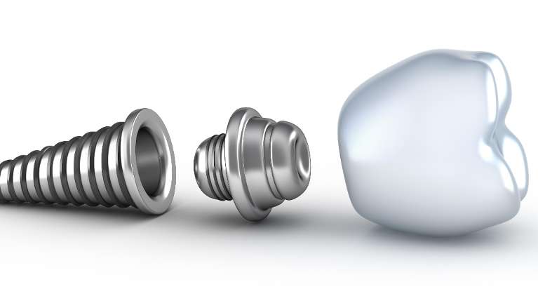 dental implants bradenton fl