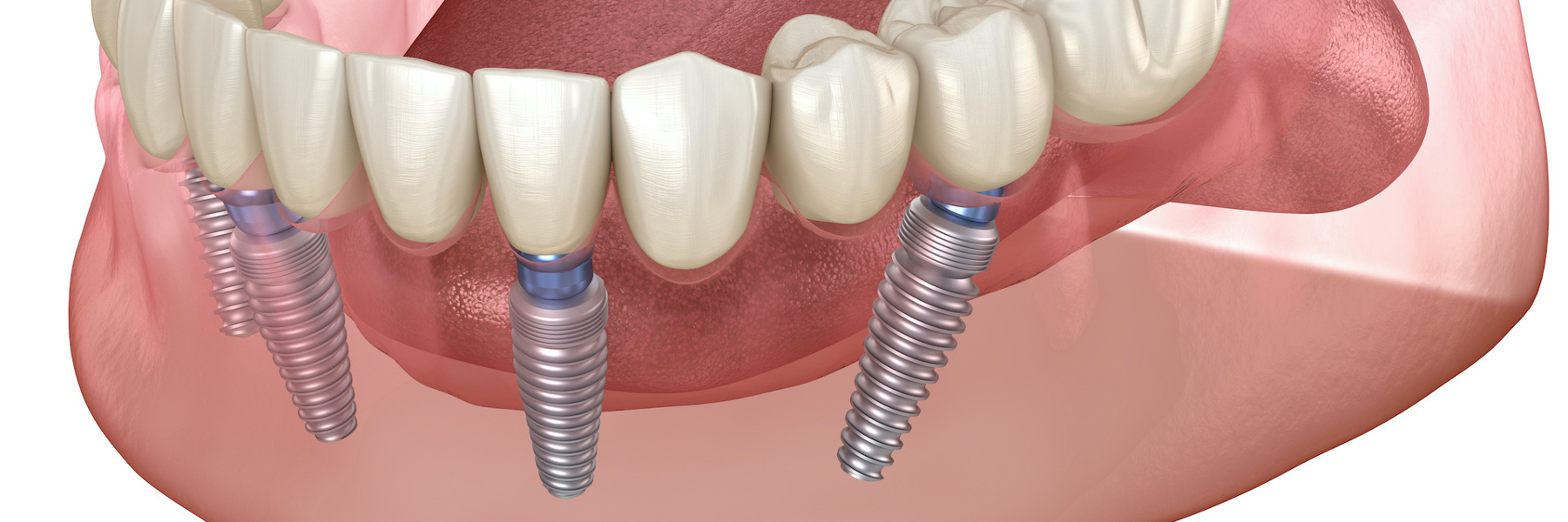 3D illustration of implant-supported denture with four titanium screws anchored in jawbone