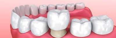 Dental crown illustration | how a dental crown works