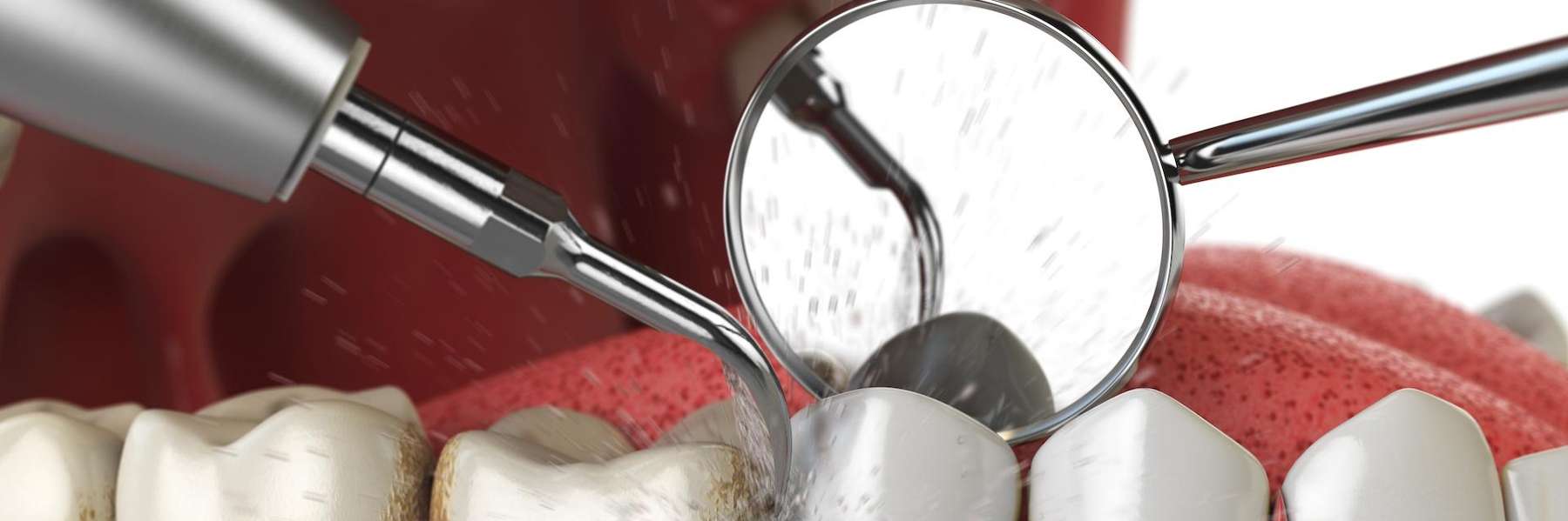 image of a teeth cleaning in brandon fl