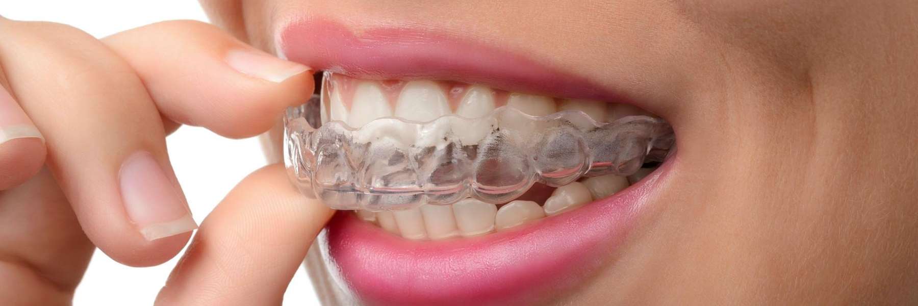 Learn more about Invisalign in Brandon, FL
