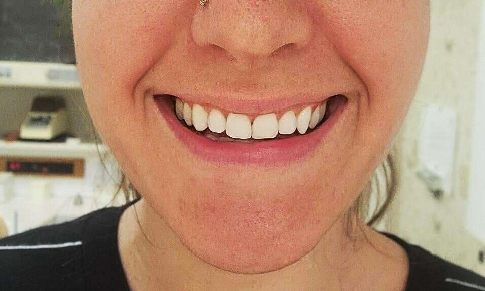 Results from lip flip at BOTOX dentist in Brandon, FL