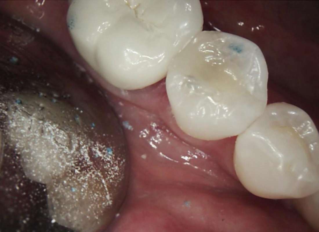Patient teeth after composite fillings in Brandon, FL