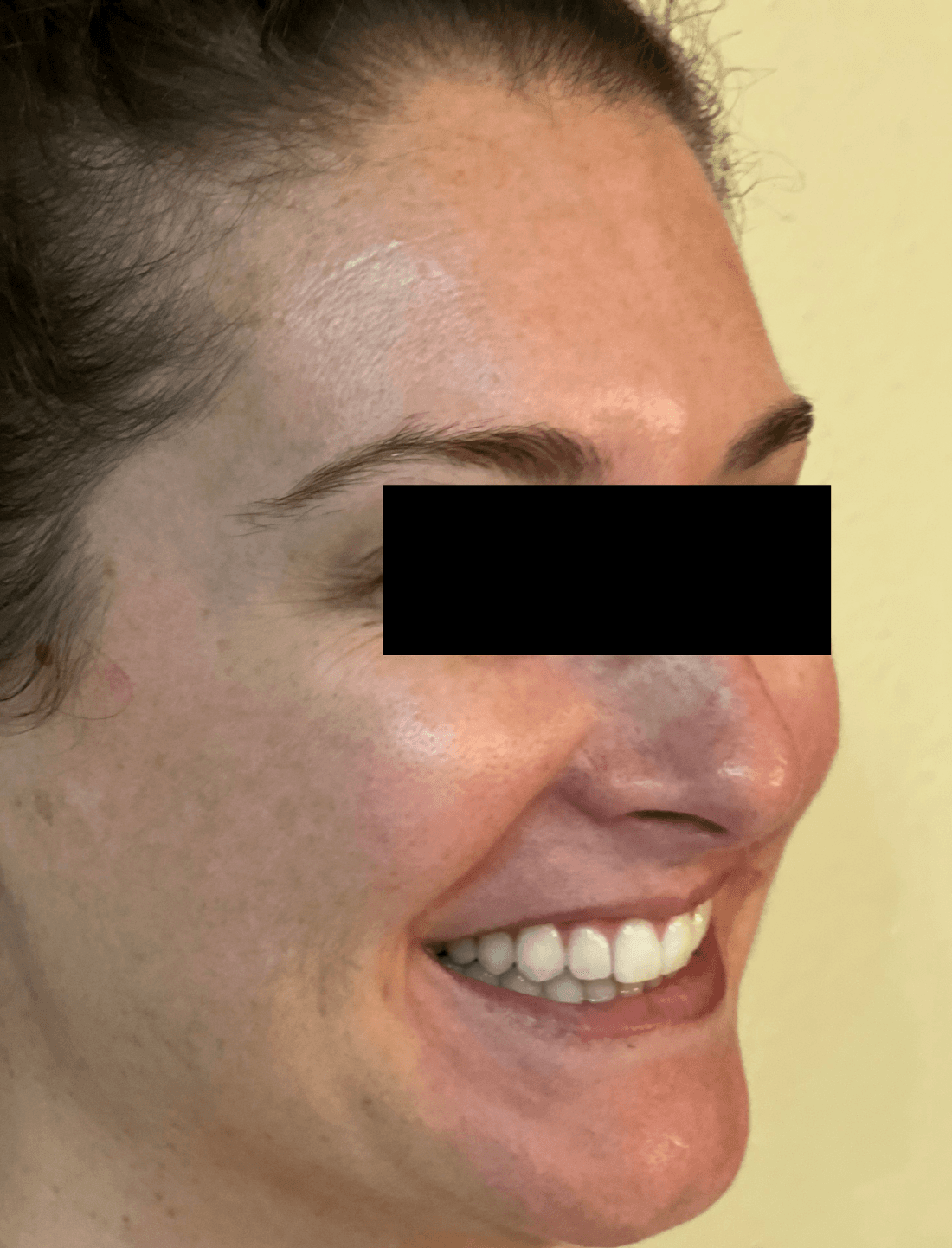 Results from BOTOX injections for crows feet at dentist in Brandon, FL