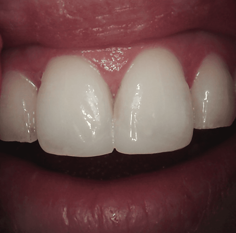 A patient's teeth after composite bonding