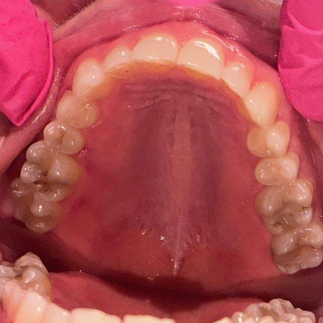 Patient's lower row of teeth before Invisalign in Brandon FL