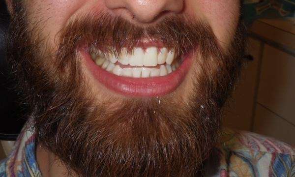 Teeth after Zoom! tooth whitening treatment in Brandon, FL