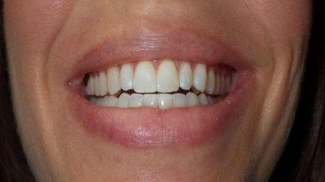 Close up of teeth after professional whitening in Brandon, FL