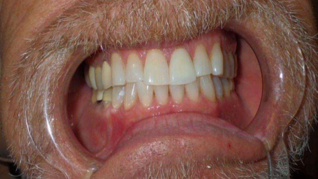 Results after Zoom! teeth whitening in Brandon, FL