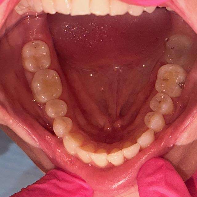 A patient's full mouth after Invisalign