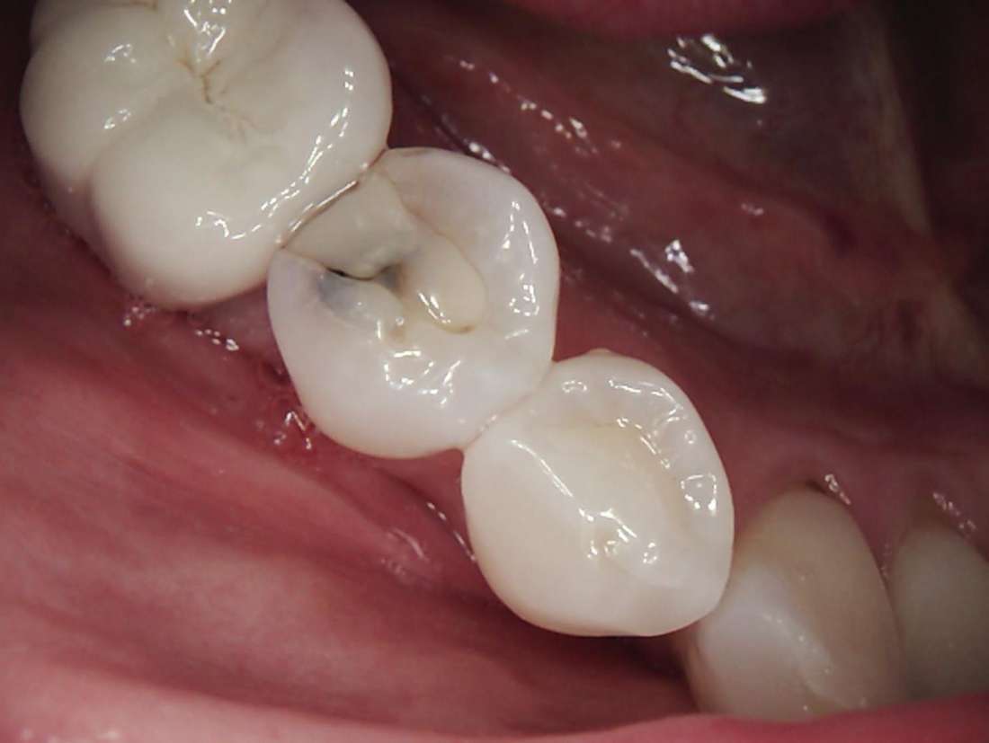 Patient teeth before composite fillings in Brandon, FL