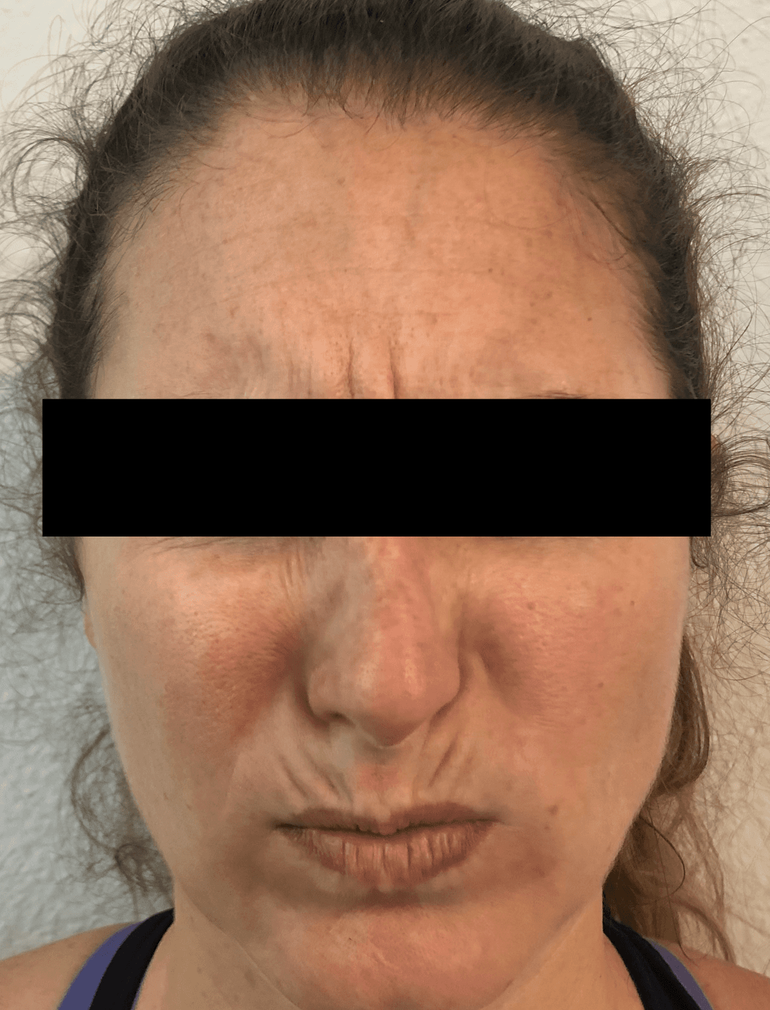 Patient showing lines on upper lip and forehead at BOTOX dentist in Brandon, FL