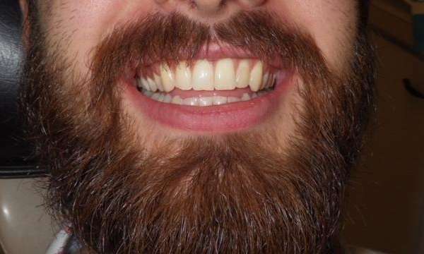 Patient's teeth before Zoom! teeth whitening treatment in Brandon, FL