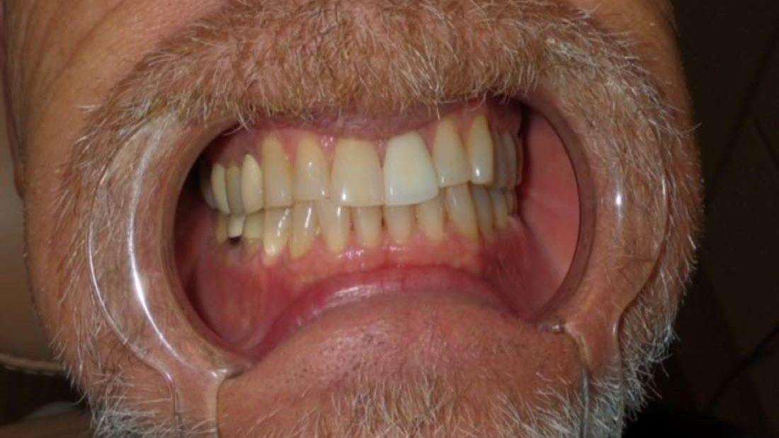 Close up of teeth before Zoom! whitening in Brandon, FL