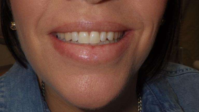 Teeth before professional tooth whitening in Brandon, FL