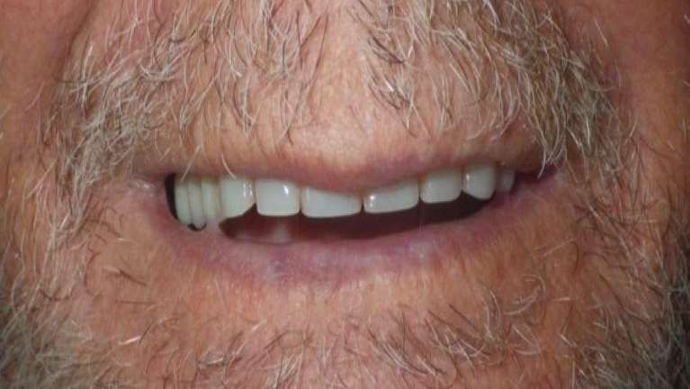 Patient's teeth after placement of All-on-Four implant dentures in Brandon, FL