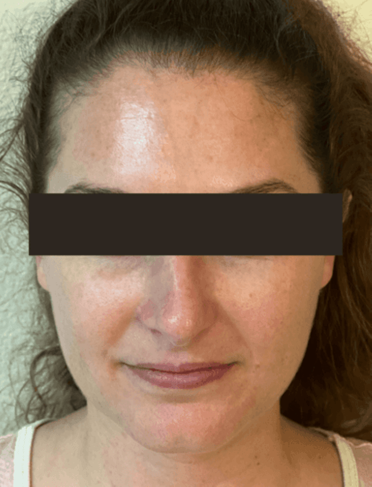 BOTOX-Frontalis-Forehead-Lines-After-Image