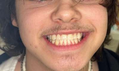 Composite-Veneers-Bonding-After-Image