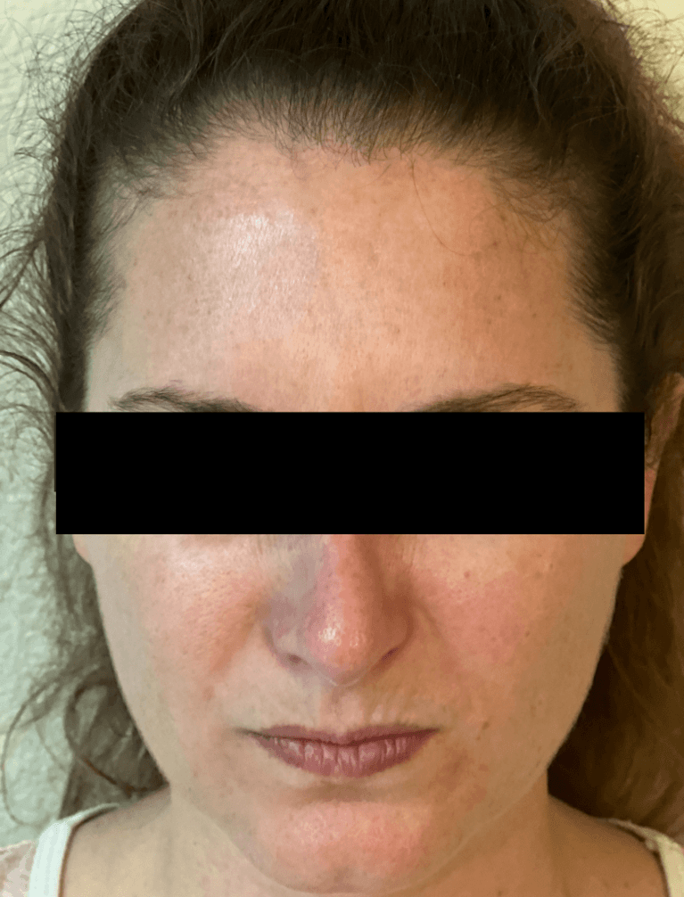 Glabellar-11-s-Lines-After-Image