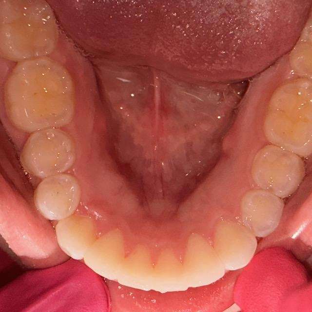 Invisalign-Clear-Aligners-After-Image