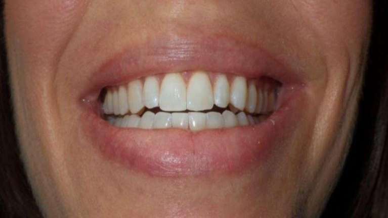 Zoom-Whitening-After-Image