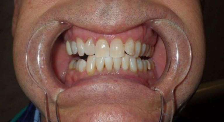 Patient results from teeth whitening in Brandon, FL