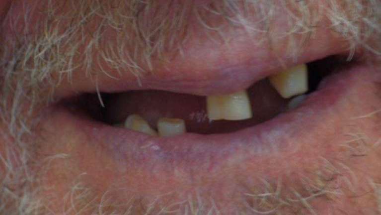 Close up of patient's smile with missing teeth at dentist in Brandon, FL
