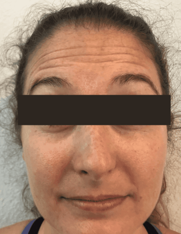 BOTOX-Frontalis-Forehead-Lines-Before-Image