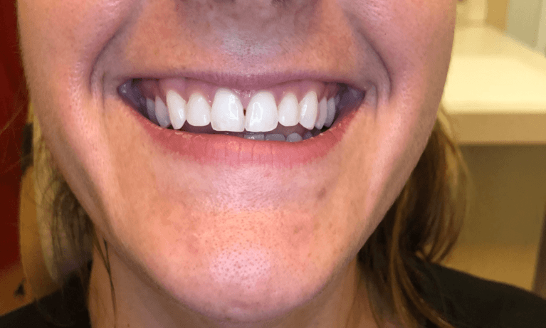 Patient's smile before lip flip at BOTOX dentist in Brandon, FL