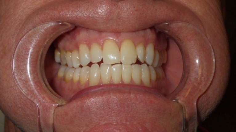 Close up of patient's smile before Zoom! teeth whitening in Brandon, FL
