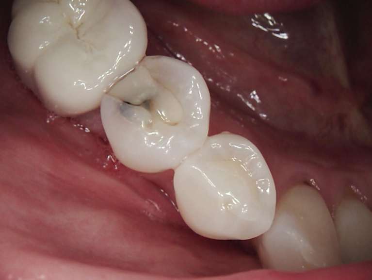 Patient teeth before composite fillings in Brandon, FL