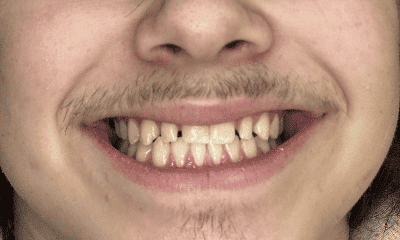Composite-Veneers-Bonding-Before-Image