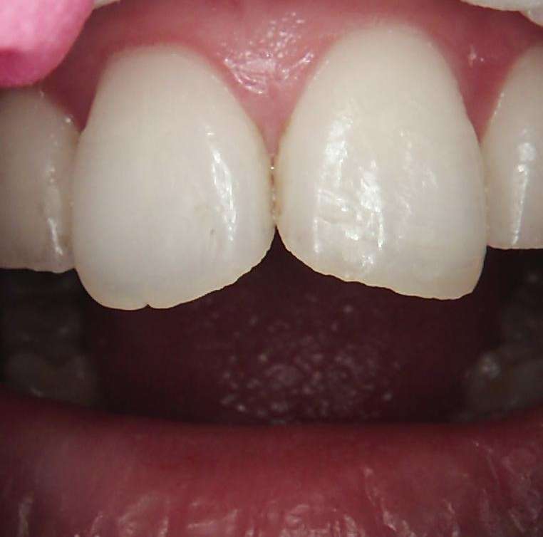 A patient's teeth before composite bonding