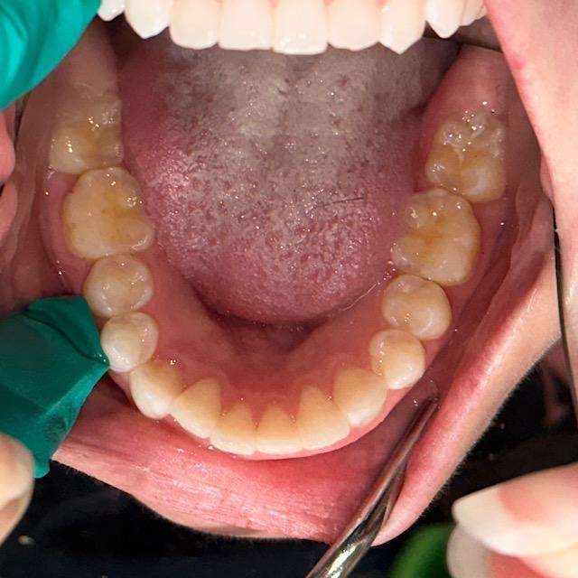 Invisalign-Clear-Aligners-Before-Image