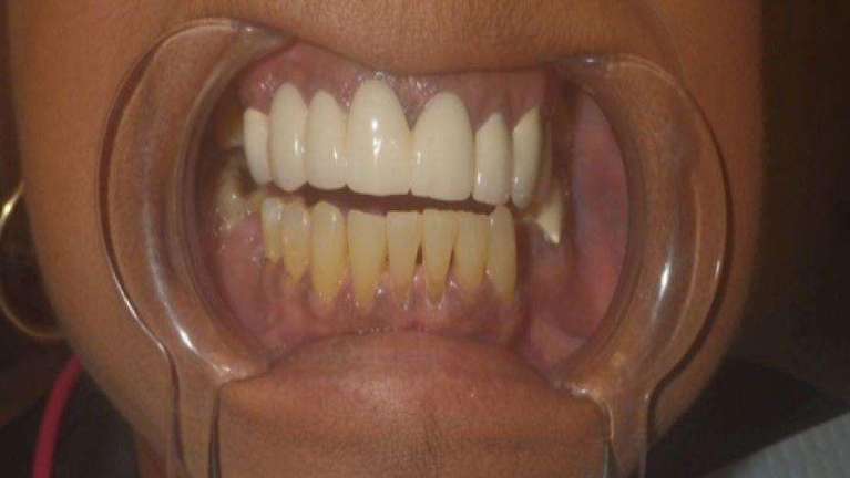 Close up of teeth before whitening at dentist in Brandon, FL