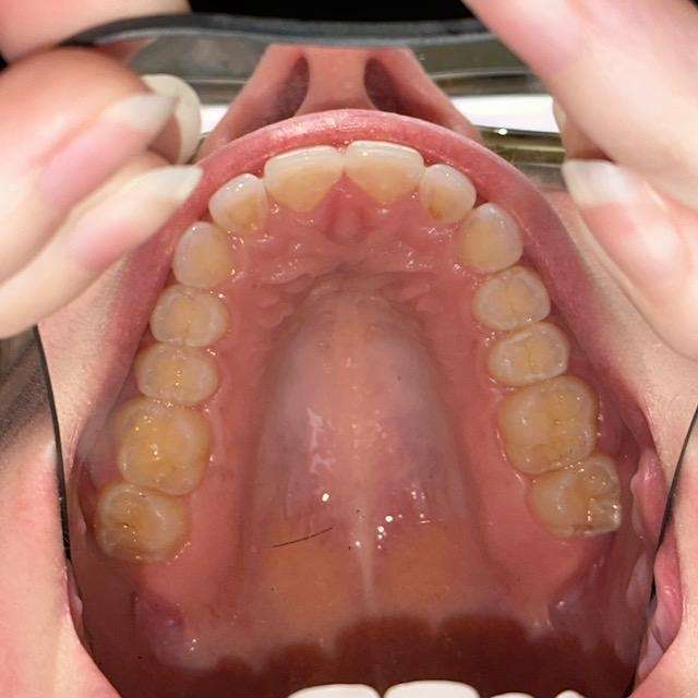 Upper row of teeth before Invisalign