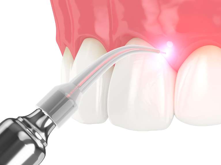 Picasso diode laser at dentist in Brandon, FL